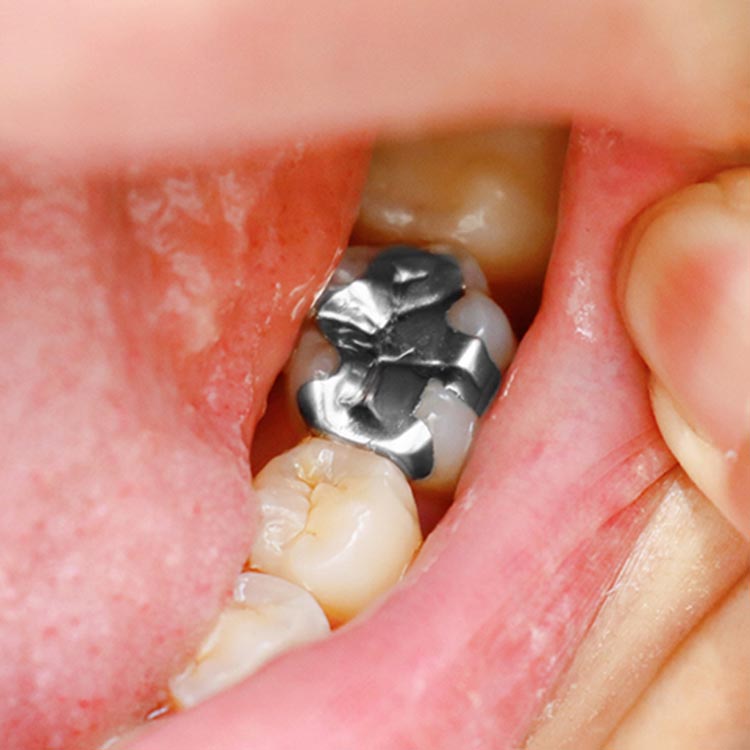 銀歯（保険適用）の写真