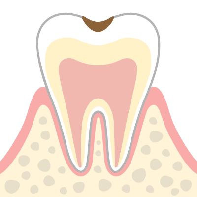 進行段階C1（エナメル質のむし歯）のイメージイラスト