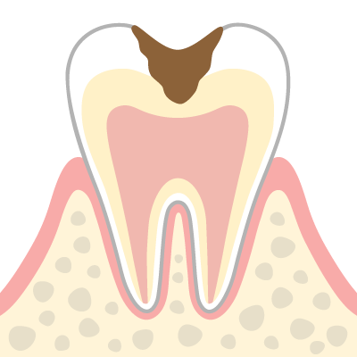 進行段階C2（象牙質のむし歯）のイメージイラスト