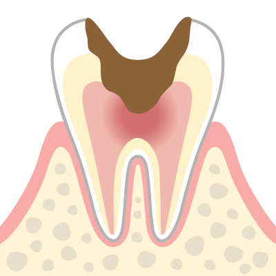 進行段階C3（神経まで進行したむし歯）のイメージイラスト