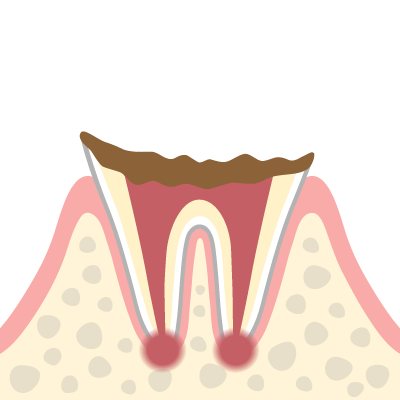進行段階C4（歯の根まで進行したむし歯）のイメージイラスト
